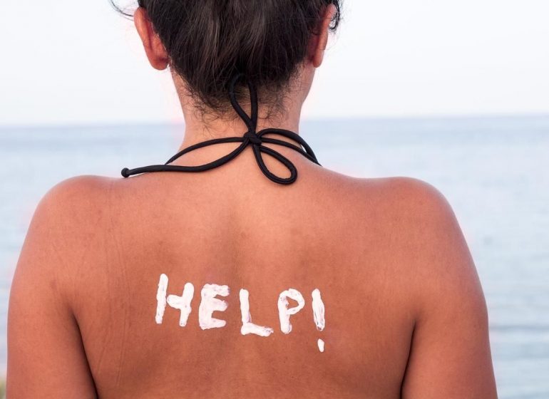 coup-de-soleil-770×560